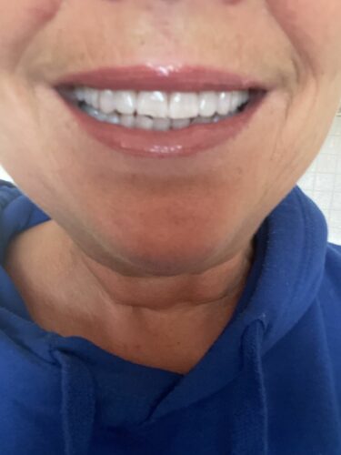 Ultraschallgerät 5in1 Dental PRO® miDent photo review