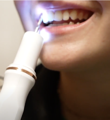 Truesonic Ultraschall-Zahnreiniger photo review
