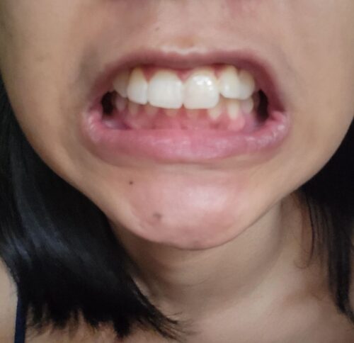 Orthodontische Zahnspangen zum Schlafen photo review